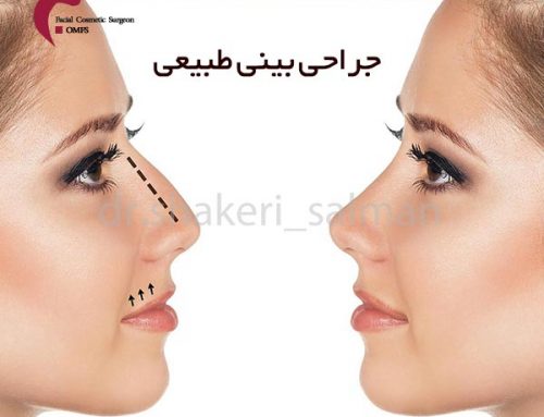 جراحی بینی طبیعی + جراح بینی شیراز + دکتر سلمان شاکری