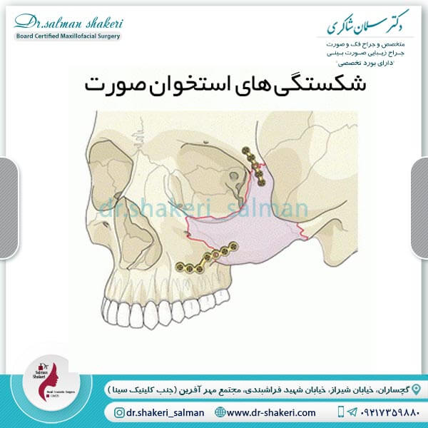 شکستگی های استخوان صورت