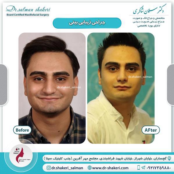 قبل و بعد از عمل ترمیمی آقا - دکتر شاکری