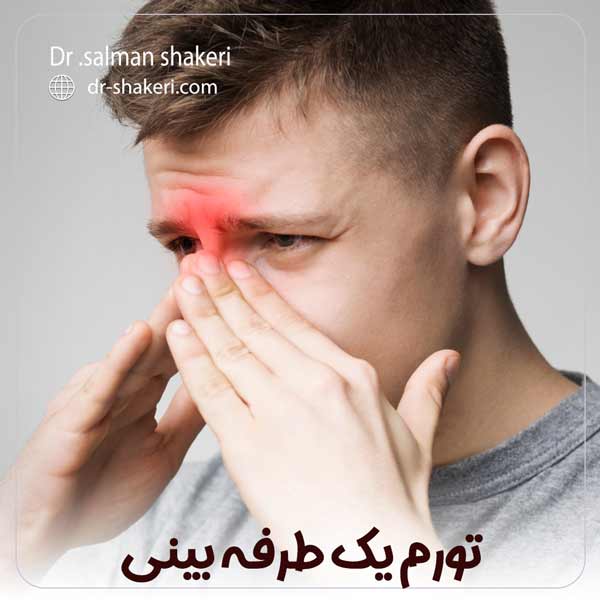 تورم یک طرفه بینی - دکتر سلمان شاکری