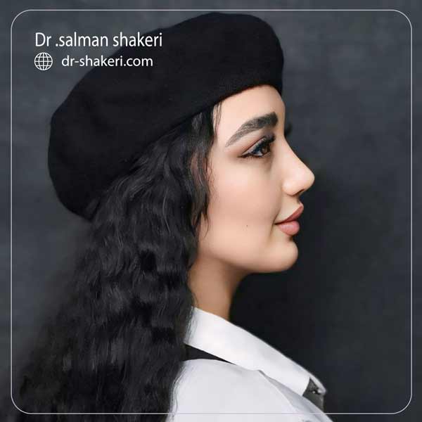 جراحی بینی استخوانی در شیراز - دکتر سلمان شاکری