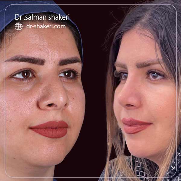 جراحی بینی استخوانی در شیراز - دکتر سلمان شاکری