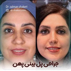 جراحی پل بینی پهن در شیراز - دکتر سلمان شاکری 