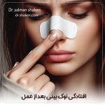 افتادگی نوک بینی بعد از عمل - دکتر سلمان شاکری