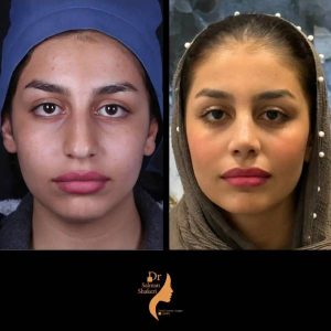 عکس عمل بینی