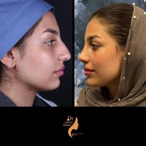 عکس عمل بینی