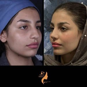 نمونه کار جراحی بینی در شیراز