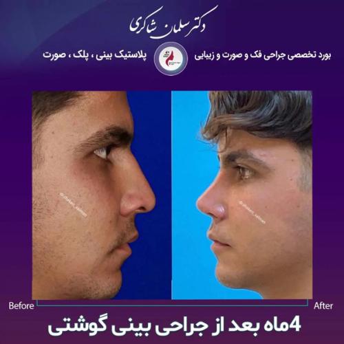 Rhinoplasty-174