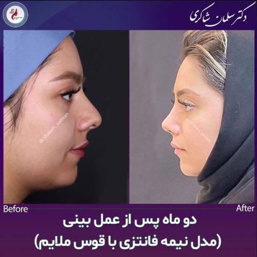 Rhinoplasty-215