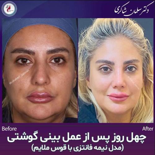 Rhinoplasty-225