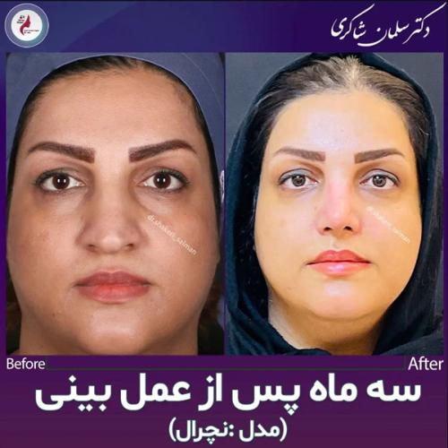 Rhinoplasty-229