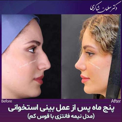 Rhinoplasty-239