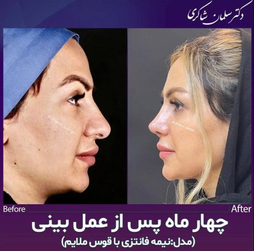 Rhinoplasty-250