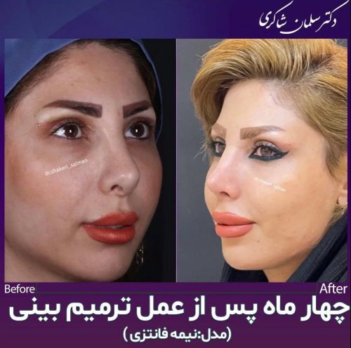 Rhinoplasty-253
