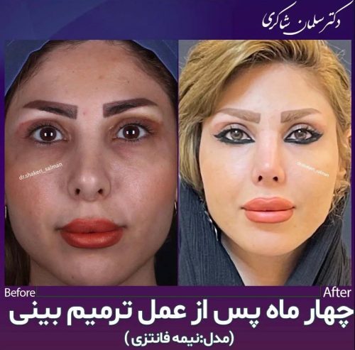 Rhinoplasty-254