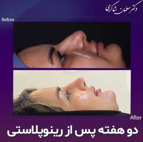 Rhinoplasty-256