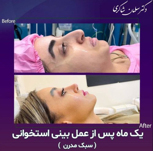 Rhinoplasty-268