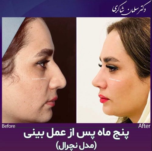 Rhinoplasty-271