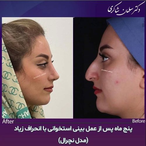 Rhinoplasty-274
