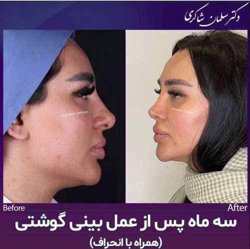 Rhinoplasty-285