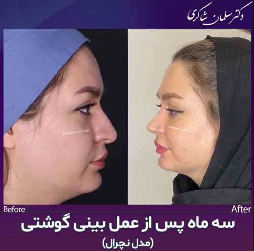 Rhinoplasty-290