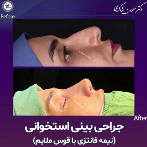Rhinoplasty-294