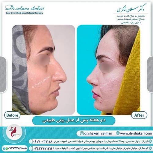 جراحی-بینی-129 (1) (1)