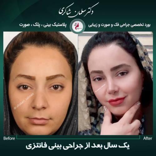 جراحی-بینی-169