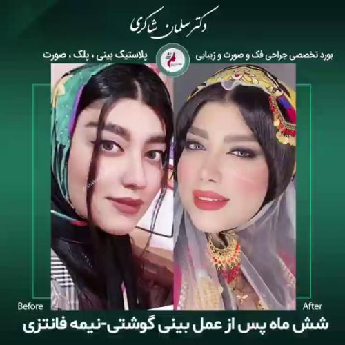 جراحی-بینی-172