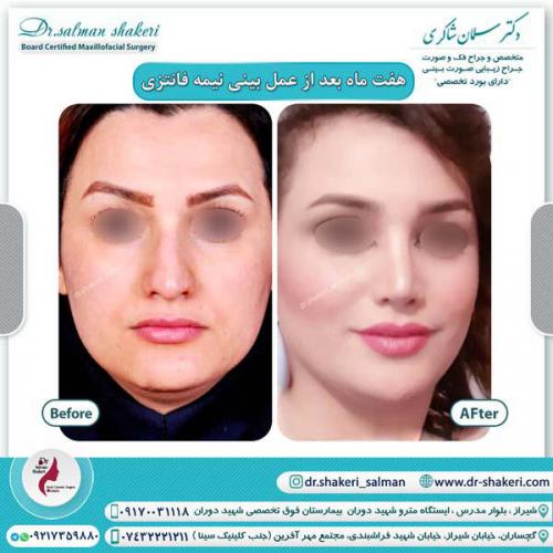 جراحی بینی 100