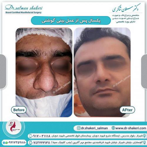 جراحی بینی 101