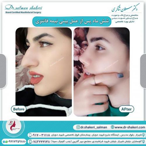 جراحی بینی 103