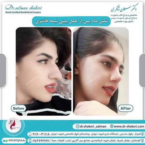 جراحی بینی 104