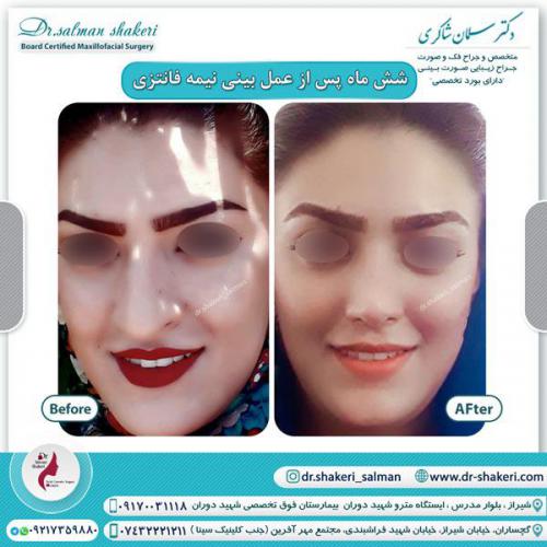 جراحی بینی 106