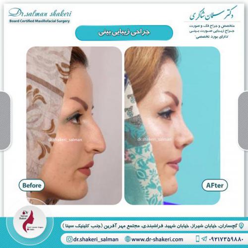 جراحی بینی 19