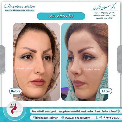 جراحی بینی 20 (1)