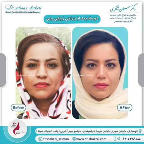 جراحی بینی 21