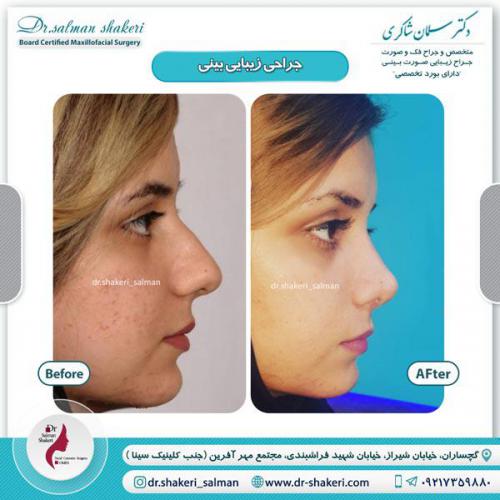 جراحی بینی 22