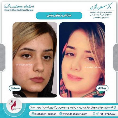 جراحی بینی 23