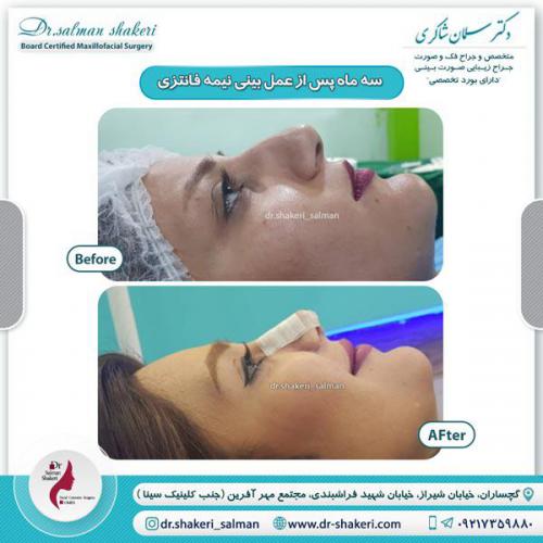 جراحی بینی 25