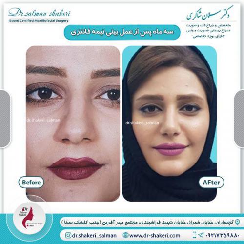 جراحی بینی 26