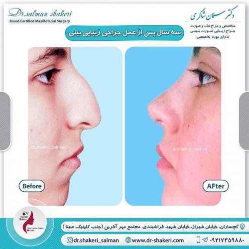 جراحی بینی 28