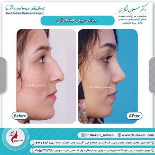 جراحی بینی 29