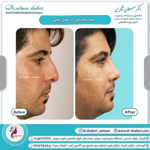 جراحی بینی 30