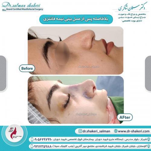 جراحی بینی 32