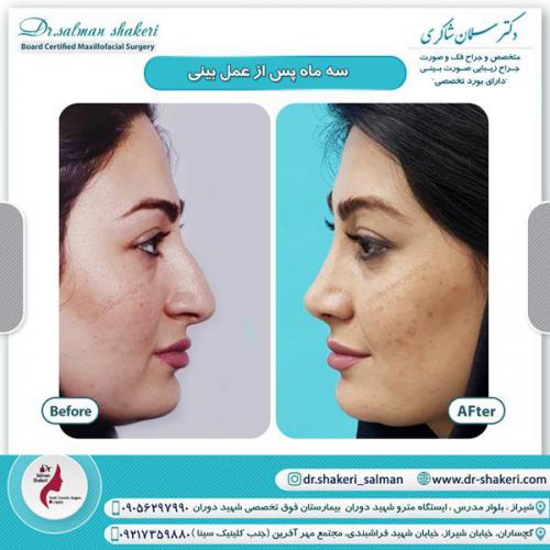 جراحی بینی 35