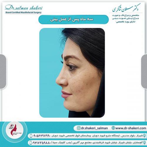 جراحی بینی 36