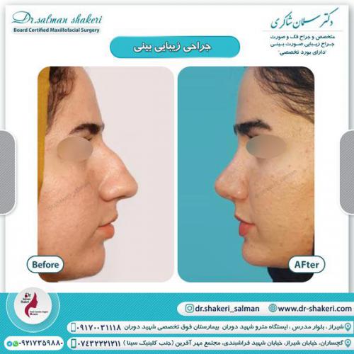 جراحی بینی 37