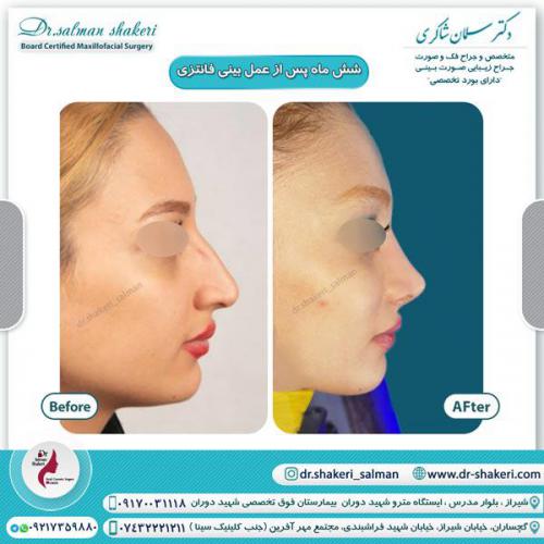 جراحی بینی 38