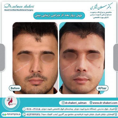 جراحی بینی 39